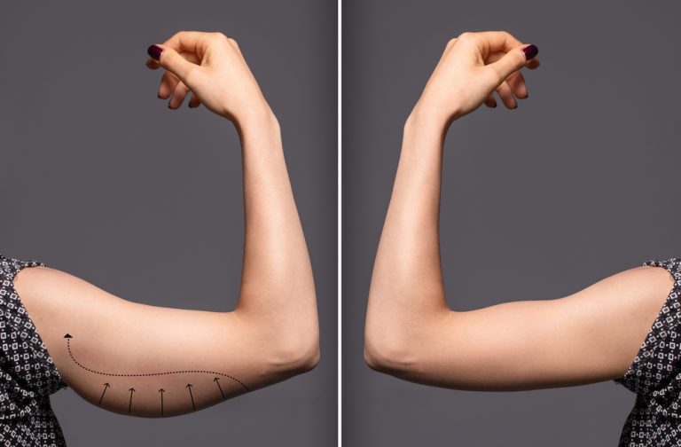 Coolsculpting Arms