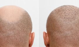 Most Popular Hair Transplant Methods in the UK