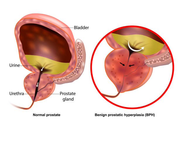 Benign Prostatic Hyperplasia
