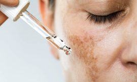 Melasma During Pregnancy: Causes, Prevention, and Safe Treatments
