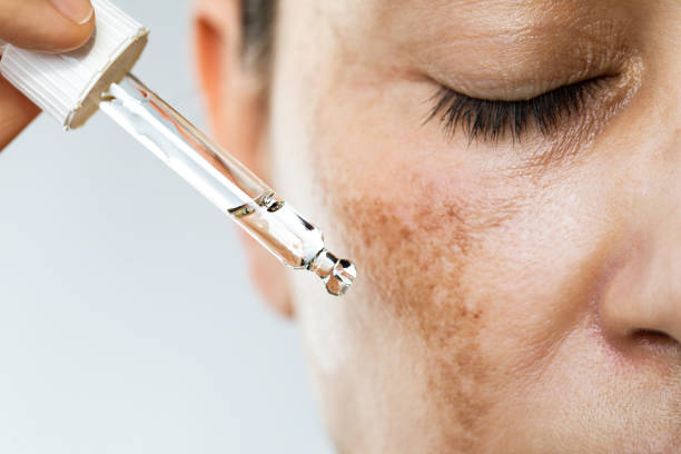 Melasma During Pregnancy