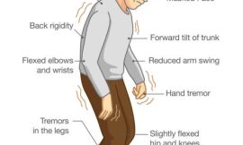 Understanding Parkinson’s Disease: Common Symptoms and Treatment Options