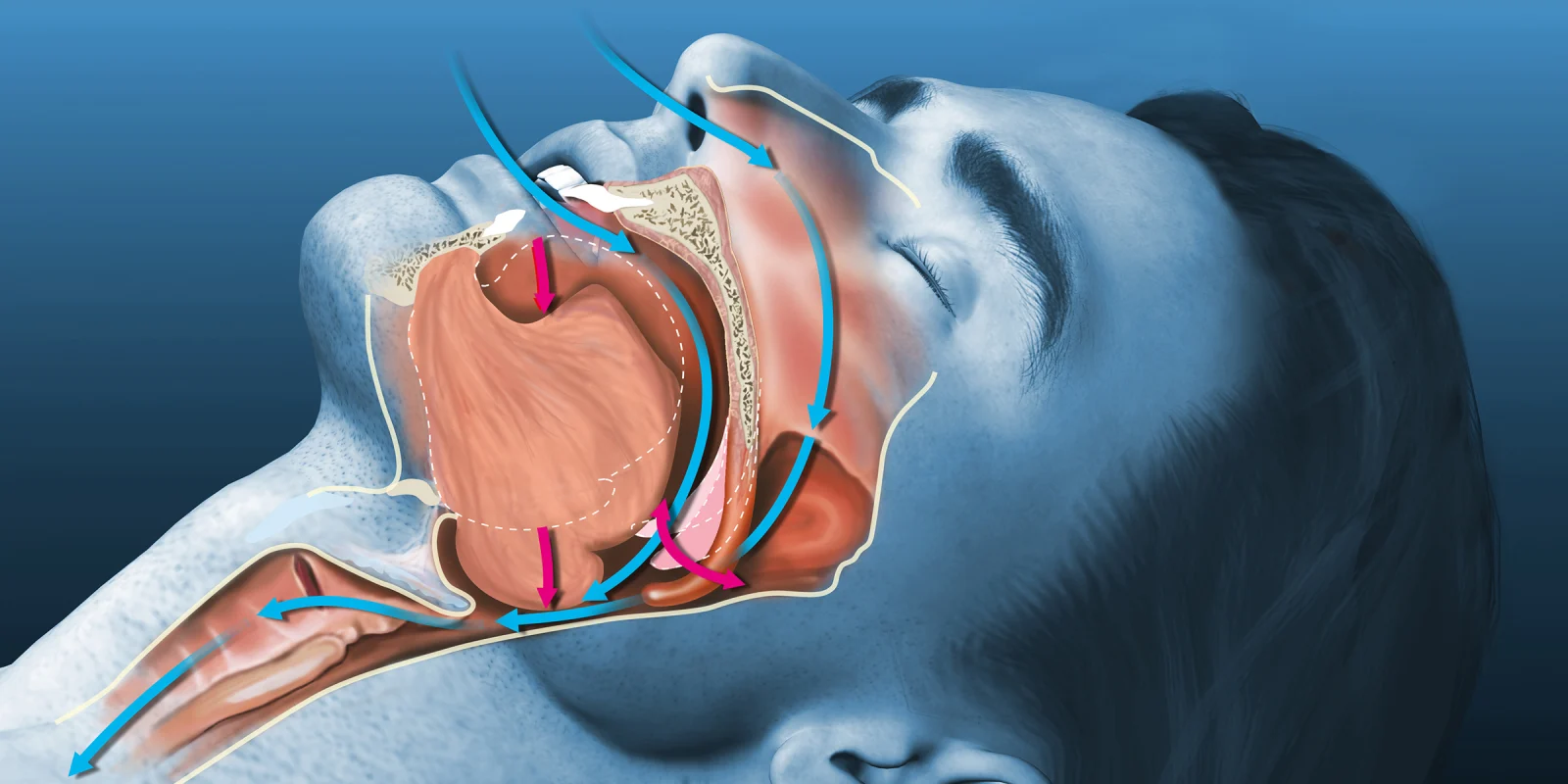 obstructive sleep apnea